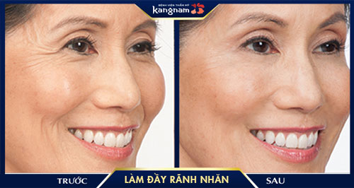 khách hàng Làm đầy rãnh nhăn 