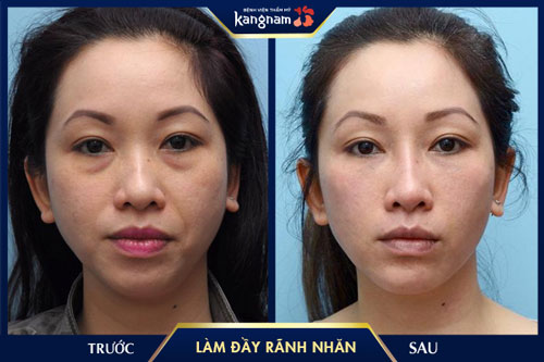 Làm đầy rãnh nhăn kangnam
