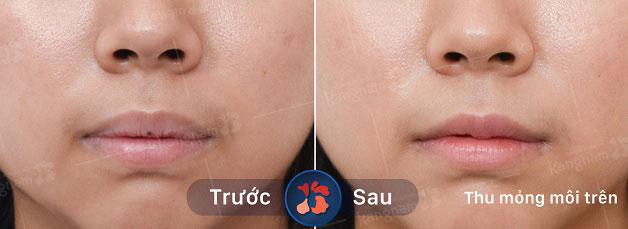 Khách hàng thu mỏng môi trên tại Kangnam