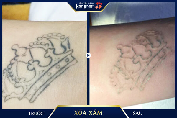 xóa xăm Laser Picosure