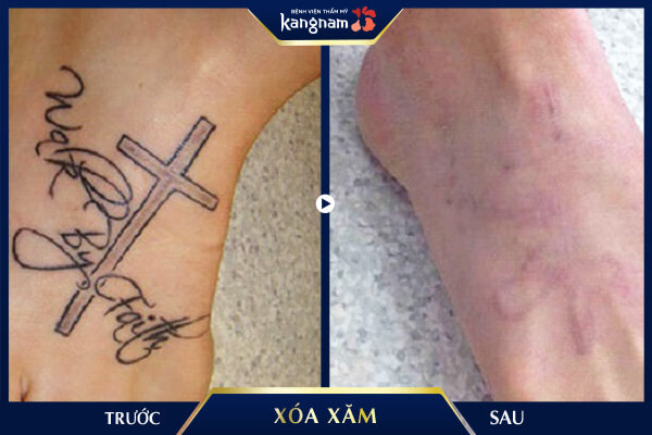 kết quả xóa xăm