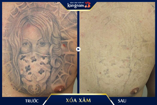 Xóa xăm Laser Picosure