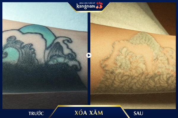 Xóa xăm Laser Picosure