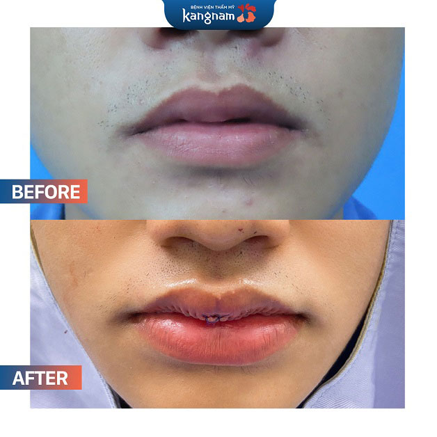 Làm mỏng môi có an toàn không?