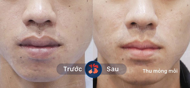 Khách hàng thu mỏng môi tại Kangnam