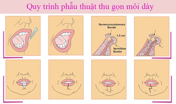 Quy trình làm mỏng môi dày theo các bước Quy trình làm mỏng môi dày theo các bước