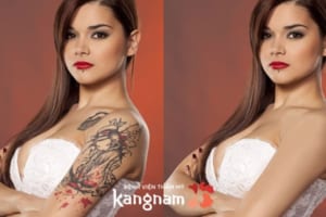 Laser Picosure – Xóa xăm nhanh chóng không để lại sẹo