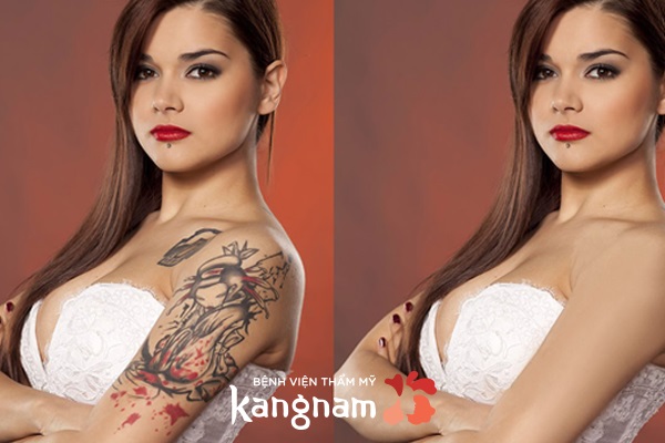 Laser Picosure – Xóa xăm nhanh chóng không để lại sẹo