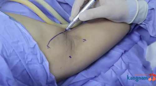 Bác sĩ khoanh vùng tuyến mồ hôi để xác định chuẩn xác vùng da cần can thiệp trị hôi nách bằng nội soi