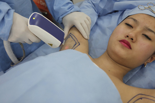 Chùm tia sóng Laser tác động sâu giúp phá hủy liên kết màng nhầy, vi khuẩn gây mùi trị hôi nách nội soi