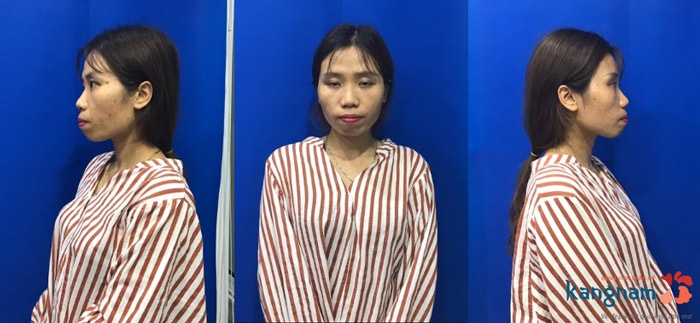 hình ảnh trước lột xác hoàng oanh