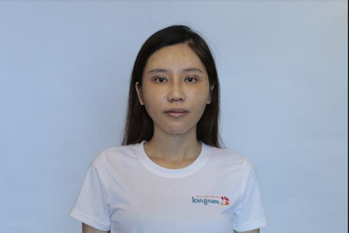 Băng ép mặt được tháo, mặt đã hồi phục nhưng chưa tự nhiên nguyễn hoàng oanh - hành trình lột xác 2018 10