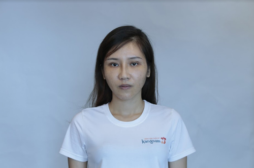 Đường nét rõ ràng, tự nhiên, không còn tình trạng sưng nề nguyễn hoàng oanh - hành trình lột xác 2018 11