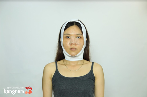 Mặt còn sưng phù nhẹ, bắt đầu xuất hiện các đường nét rõ ràng nguyễn hoàng oanh - hành trình lột xác 2018 8