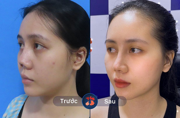 Những người có mũi hỏng, mũi xấu nên thực hiện công nghệ này để được chỉnh hình toàn diện