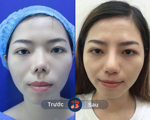 Chỉ trong khoảng thời gian ngắn, toàn bộ phần sụn mới nâng sẽ gắn kết với cấu trúc xương bên dưới cho dáng mũi bền đẹp vĩnh viễn