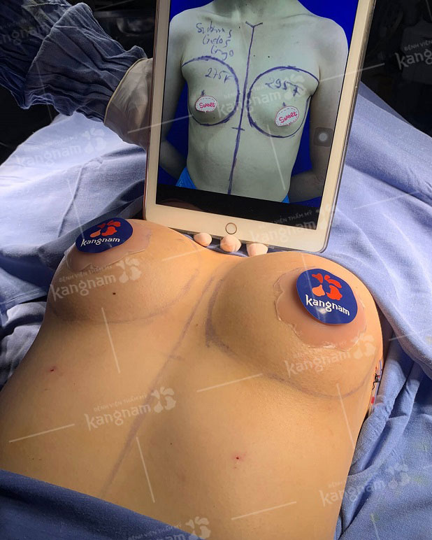 Khách hàng nâng ngực thành công