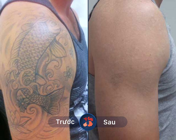 Hiệu quả xóa vết xăm lông mày bằng công nghệ Laser Picosure hiện đại