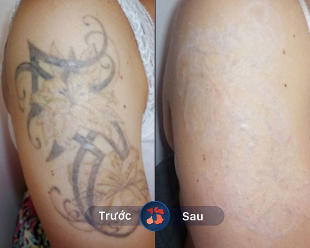 Khách hàng sau khi xóa xăm tại Kangnam