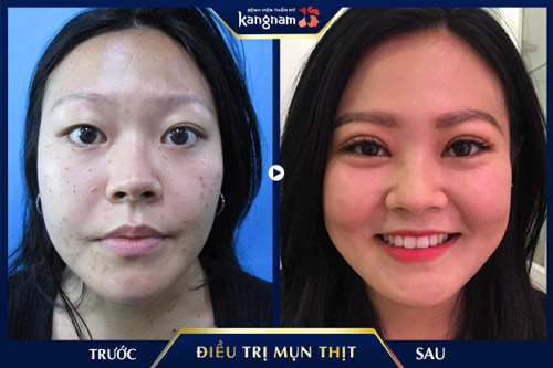 bắn laser mụn thịt