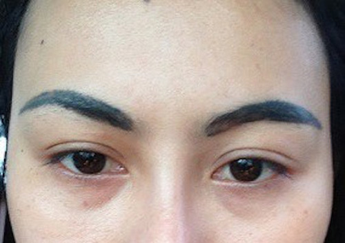 xóa xăm lông mày