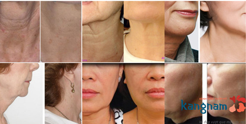 Kết quả căng da cổ đảm bảo cải thiện hơn 90% cho khách hàng chỉ sau 1 lần thực hiện vết nhăn ở cổ