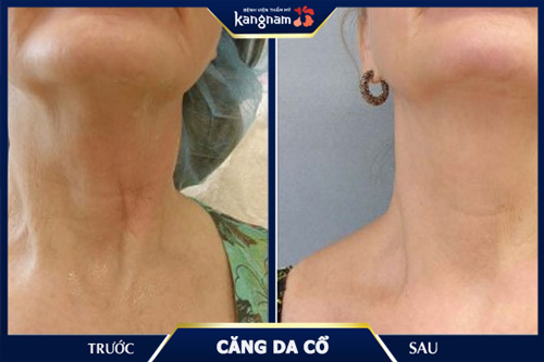 Căng da cổ nội soi giúp khách hàng khắc phục hơn 90% vùng da chảy nhão, dư thừa, lão hóa căng da cổ nội soi