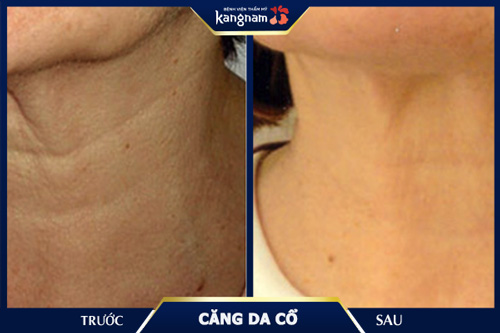 Hình ảnh căng da vùng cổ cho khách hàng có dấu hiệu chùng, chảy xệ nhiều, rãnh nếp nhăn hằn sâu căng da vùng cổ