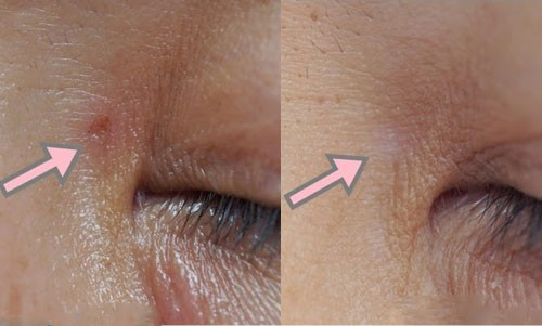 chăm sóc da mặt sau khi đốt mụn thịt