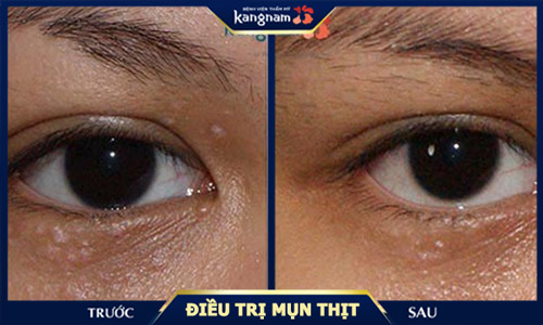 mụn thịt ở mắt