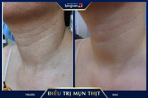 mụn thịt ở cổ