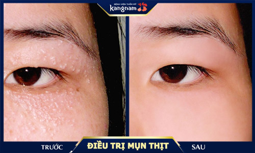 mụn thịt quanh mắt