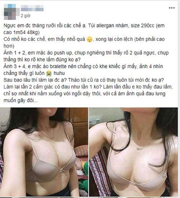 Làm ngực lần 1 chưa ưng ý, cô gái lo lắng nâng ngực lần 2 có đau không nâng ngực lần 2 có đau không