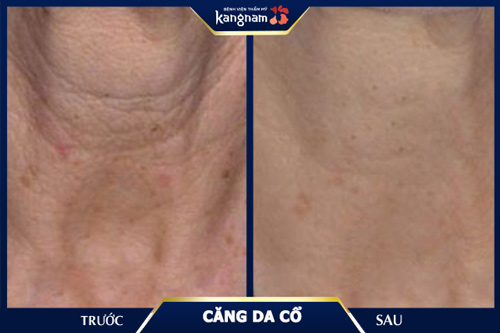 Vùng da cổ nhăn nheo được cải thiện tối đa, đem đến làn da căng đầy, đều màu hơn phẫu thuật căng da cổ
