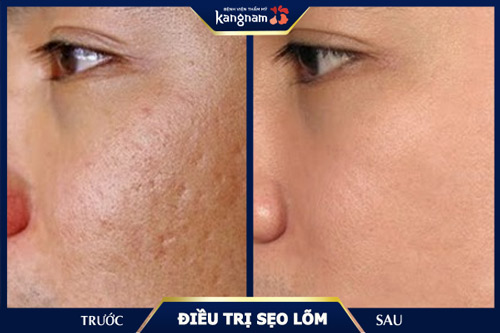 phương pháp cấy da siêu vi điểm