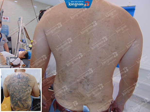 Khách hàng nam sau khi xóa xăm tại Kangnam