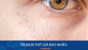 Trị mụn thịt giá bao nhiêu tiền? Bảng giá tại BV Kangnam?