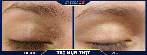Các mảng mụn thịt quanh mắt được xóa bỏ hoàn toàn, không thâm, để lại sẹo trị mụn thịt mắt