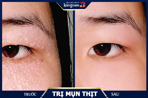 Phần mụn thịt thừa được cải thiện toàn diện, trả về làn da trắng sáng, mịn màng trị mụn thịt thừa