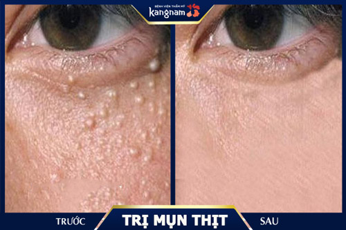 99% tình trạng mụn thịt được cải thiện sau 1 lộ trình điều trị bằng công nghệ Laser Fractional CO2 trị mụn thịt