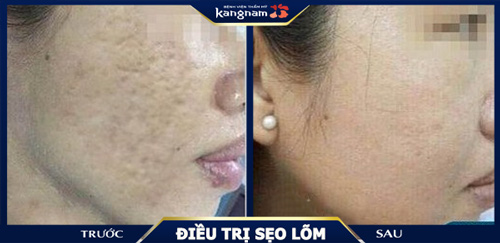trị sẹo lõm bằng cấy da siêu vi điểm