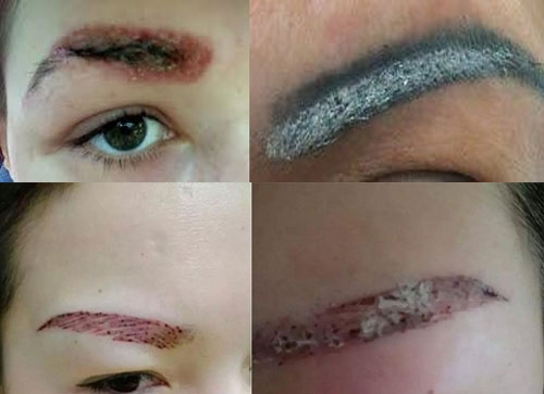 Tình trạng tự xóa xăm lông mày tại nhà có thể gây nhiễm trùng và để lại sẹo xấu xóa xăm lông mày giá bao nhiêu