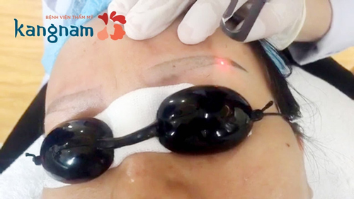 Xóa xăm lông mày bằng Laser Picosure là giải pháp tẩy mực xăm hiệu quả bậc nhất hiện nay xóa xăm chân mày bằng laser