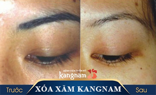 xóa phun lông mày