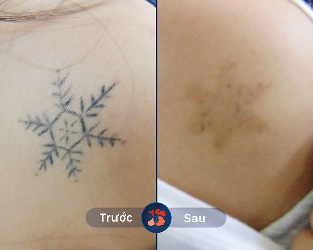 Thế hệ Laser Toning Plus - Thách thức mọi hình xăm khó