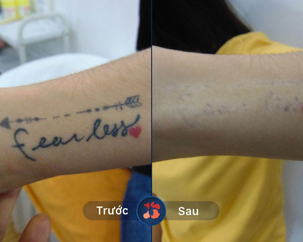 Tác động Laze chuẩn xác, không xâm lấn, không đau rát khó chịu