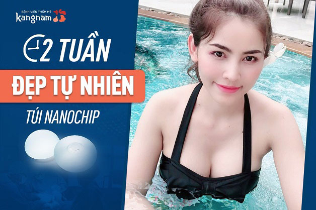 Nâng ngực Nanochip đẹp tự nhiên sau 2 tuần