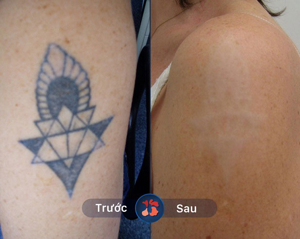 Hình xăm nhiều màu được xóa bỏ hoàn toàn