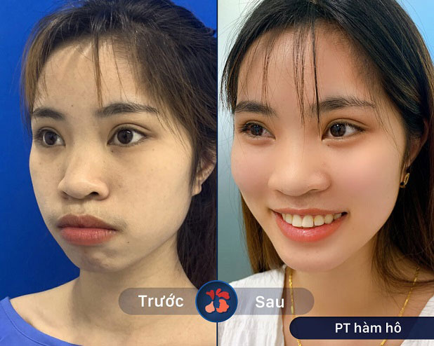Quá trình hồi phục sau phẫu thuật hàm hô của khách hàng Ngô Quế An tại BVTM Kangnam