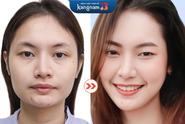 Khách hàng phẫu thuật thu gọn góc hàm V line, có ngay dáng khuôn mặt thon, trẻ trung, duyên dáng